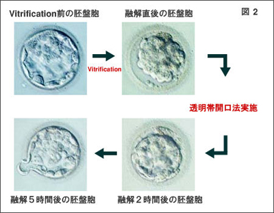 凍結した胚の融解方法